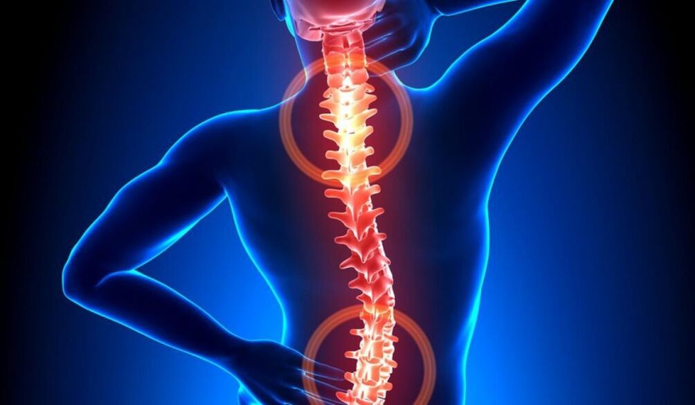 σπονδυλική οστεοχόνδρωση