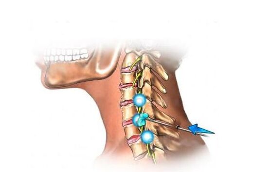 θεραπεία της οστεοχονδρωσίας του τραχήλου της μήτρας